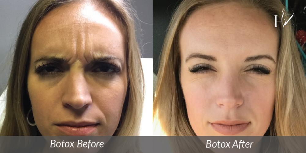 Bad botox before and after 7 day